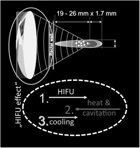 HIFU werkingsmechanisme beeld